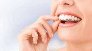 What is Invisalign