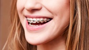 Cost Factors for Braces in Ontario