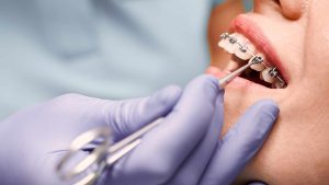 Treatment Duration of Braces in Ontario